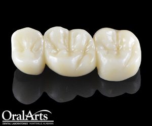 Why Patients Should Choose All Ceramic Restorations Instead Of Pfm Porcelain Fused To Metal Solaris Dental Design